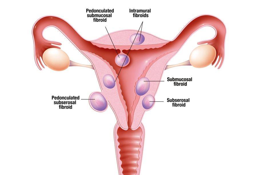 Uterine Fibroids Treatment in Prayagraj