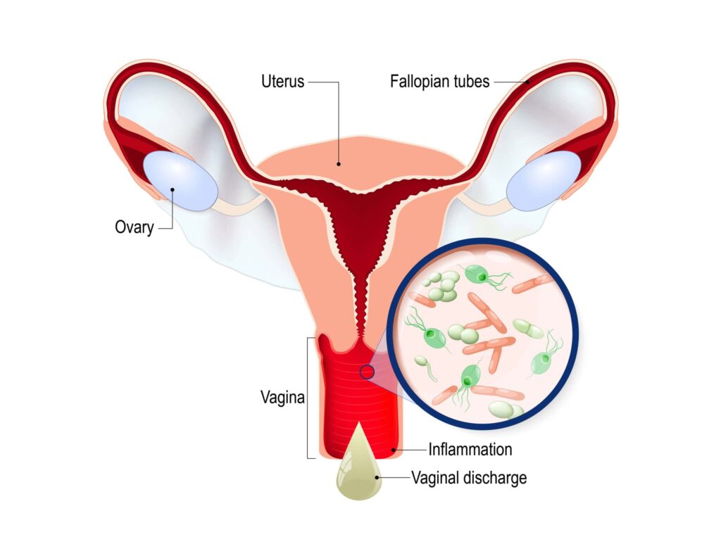 Vaginal Yeast Infection Treatment