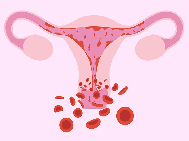 menstrual disorders treatment